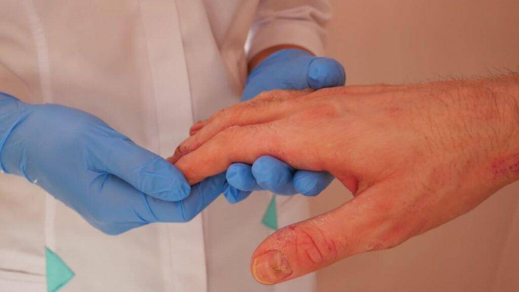 Dermatitis Demystified: Understanding Causes, Symptoms, and Treatments"