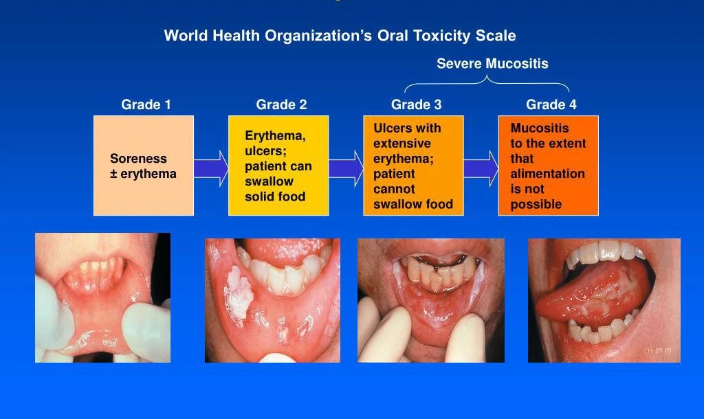 The WHO grading system for oral mucositis