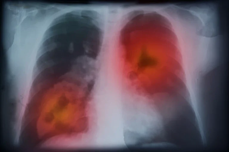 Lung Cancer Understanding the Rising Burden, Risk Factors, and Early Warning Signs