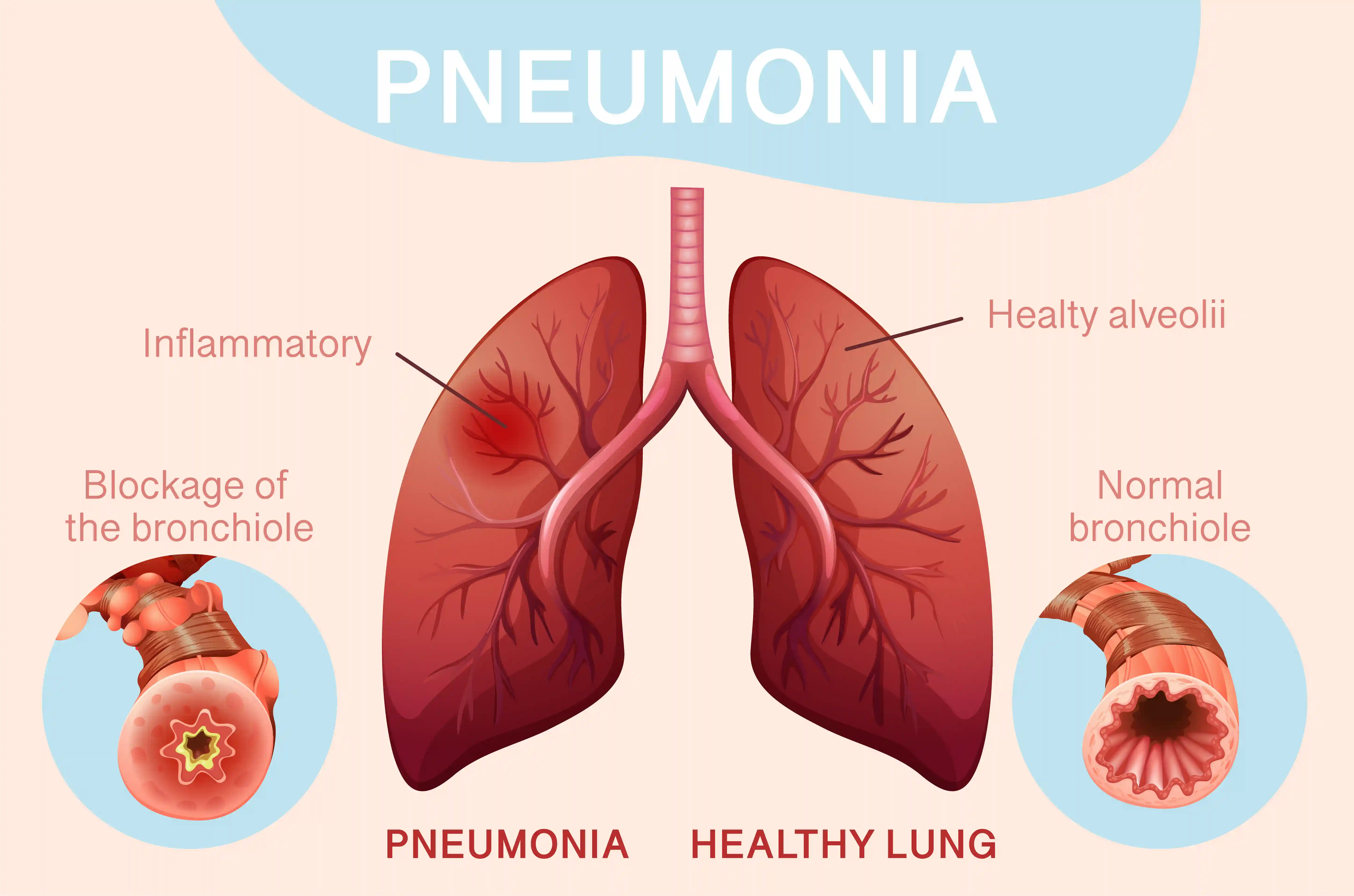 Symptoms for Lung Cancer