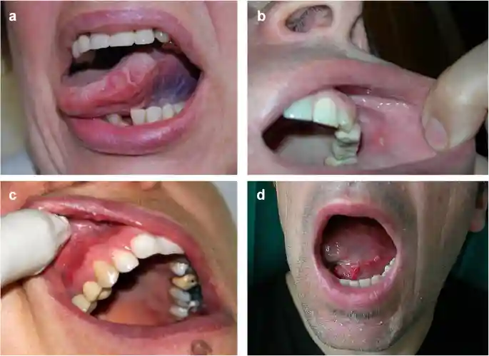 Understanding the Biology of Oral Mucositis