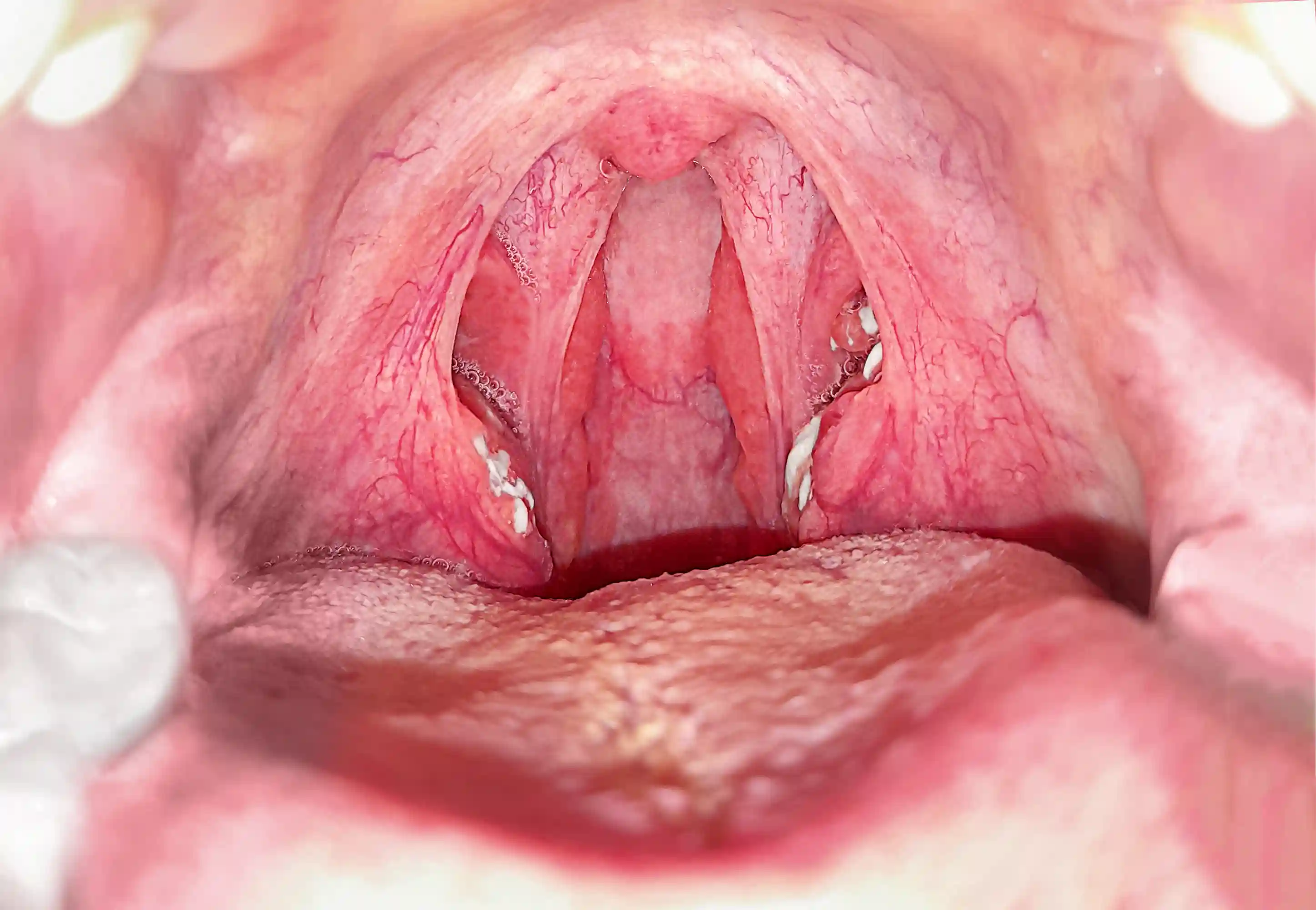 Why Oral Mucositis Matters Beyond Mouth Sores